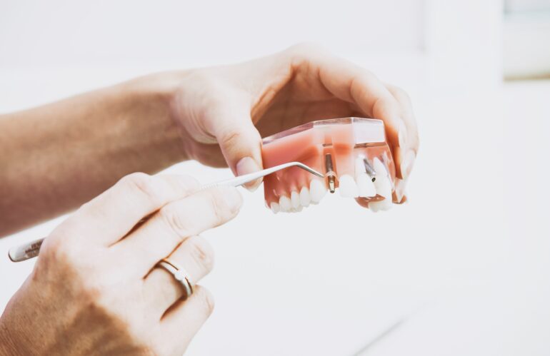 Dental model with dental implants.